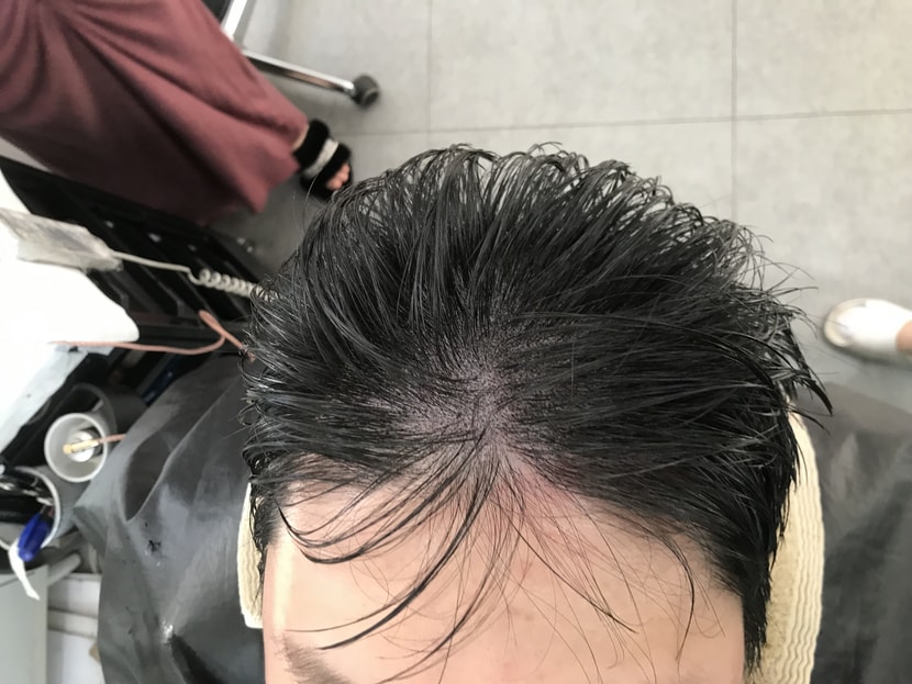 두피문신 후