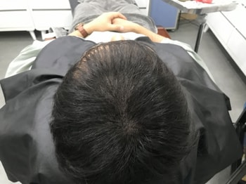 시술후 마른머리