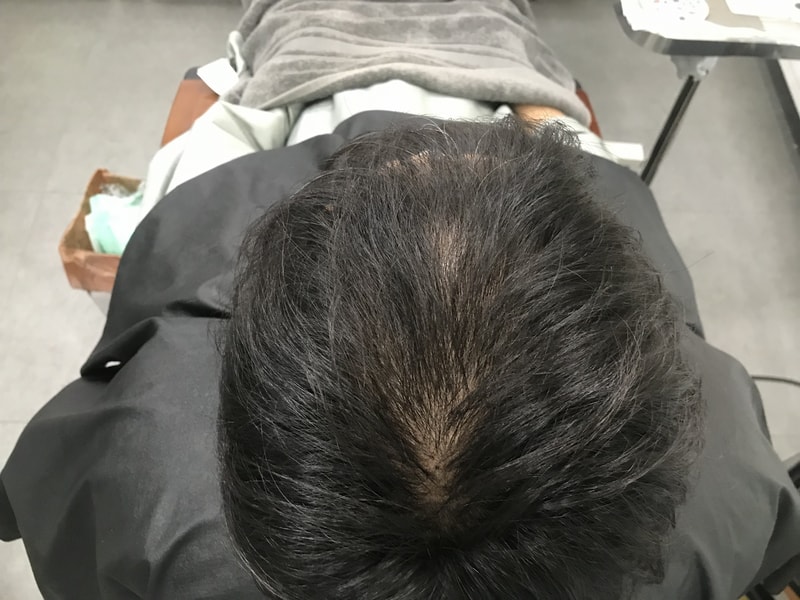 1차 수지침 두피문신 후기