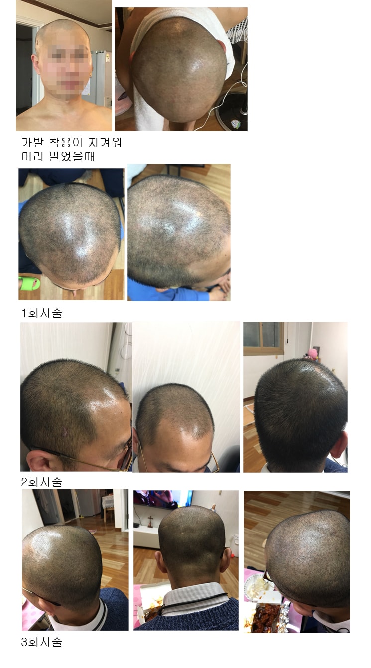두피문신 9개월 3회 시술 리얼 후기 입니다!!