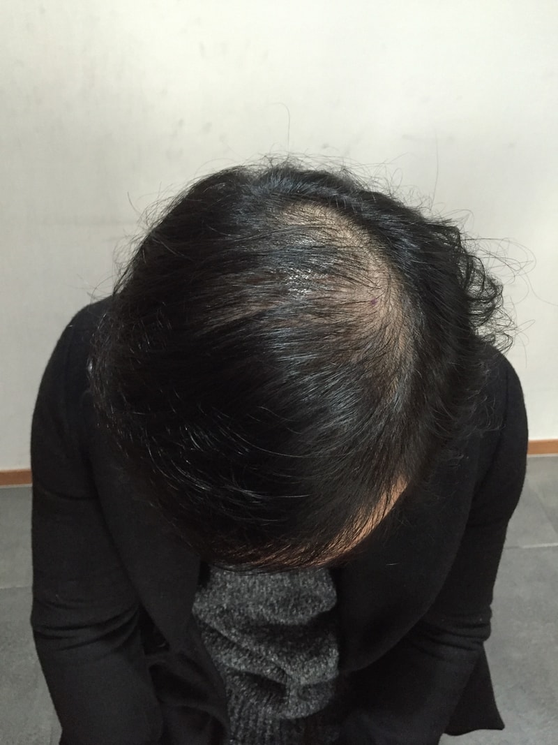 After much thought, I got my scalp tattooed yesterday!