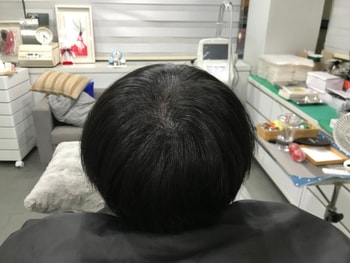 시술 후 마른 머리 사진 1 