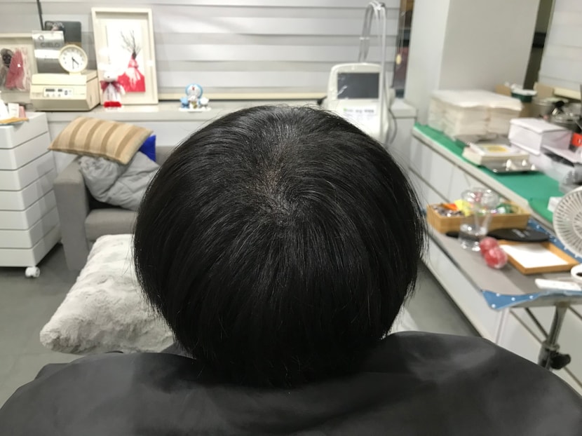 시술 후 마른 머리 사진 1 
