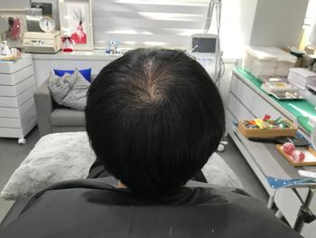 시술 전 마른 머리 사진 1 