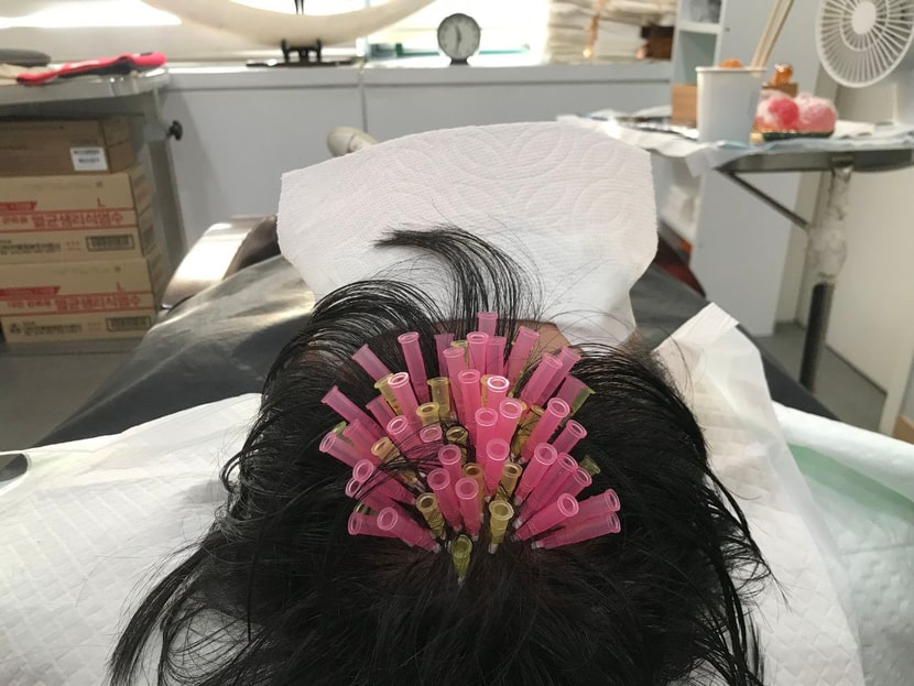 모발볼륨리프팅 사진 