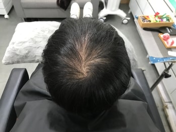 시술 전 마른 머리 사진 2 