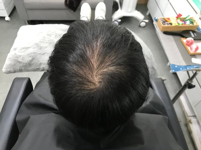 시술 전 마른 머리 사진 2 
