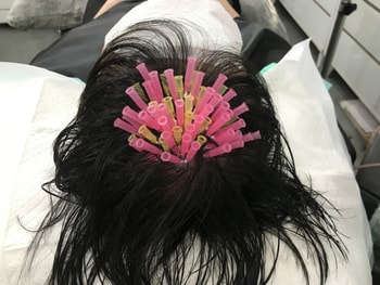모발볼륨리프팅 시술 