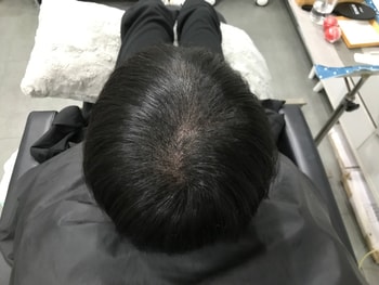 시술 후 마른 머리 사진 2