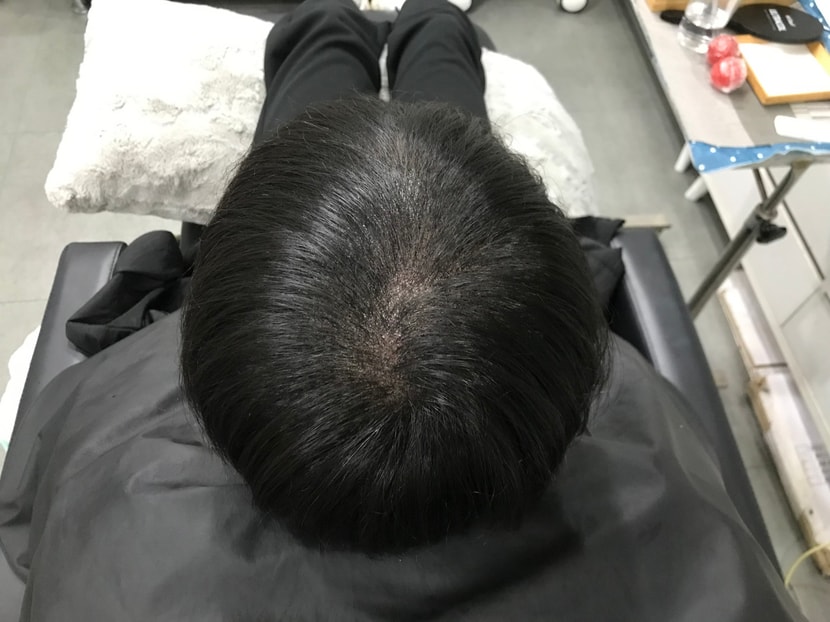 시술 후 마른 머리 사진 2
