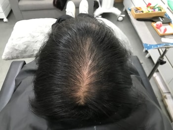 시술 전 마른 머리 사진 3 