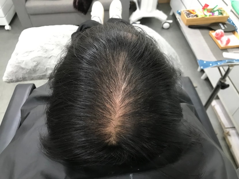 시술 전 마른 머리 사진 3 