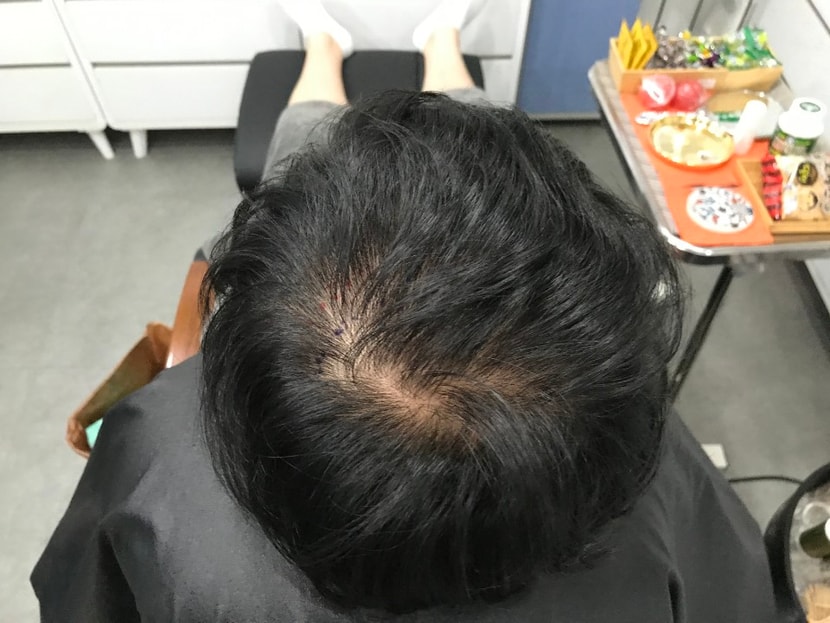시술전 마른머리