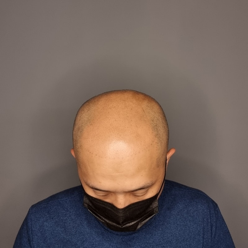 はげ頭の頭皮タトゥーリビュー