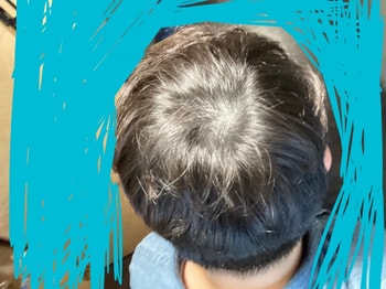 시술 2년째 백열등 바로 아래서 제가 촬영한 사진입니다.