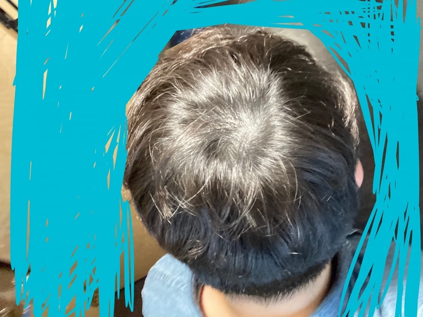시술 2년째 백열등 바로 아래서 제가 촬영한 사진입니다.