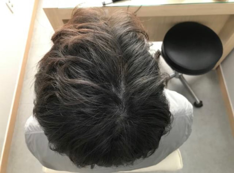 정수리 두피문신 2년차 후기 남깁니다.