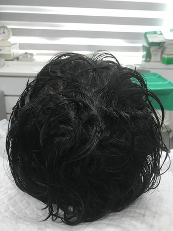 시술후 병원측제공(젖은머리)