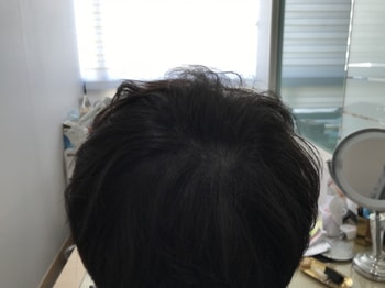 시술 2년째 병원에서 제공해준 사진입니다.