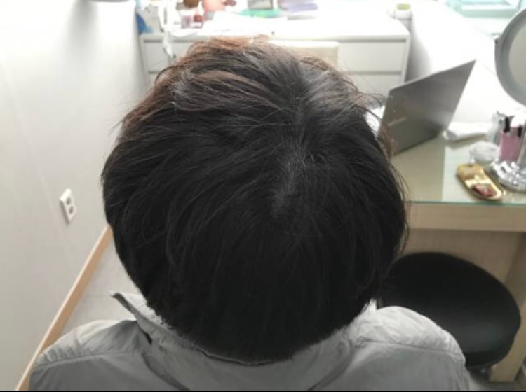 시술 1년째 병원에서 제공해준 사진입니다.