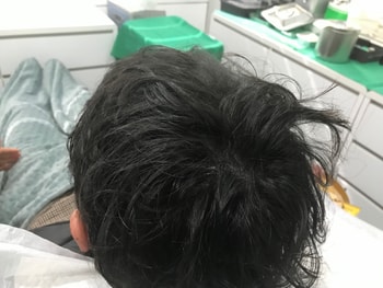 시술후 병원측제공(마른머리)