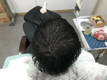 시술후