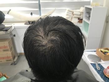 시술전