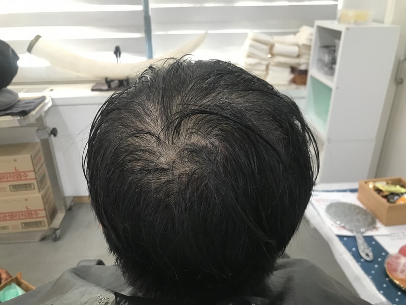 分享头皮纹身后记。