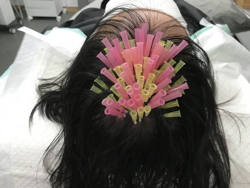 제 두피 상태가 좋지않아서 시술이 필요할 것 같다고 하셔서 같이 진행했어요