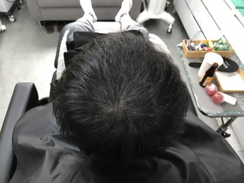 시술 후 마른상태