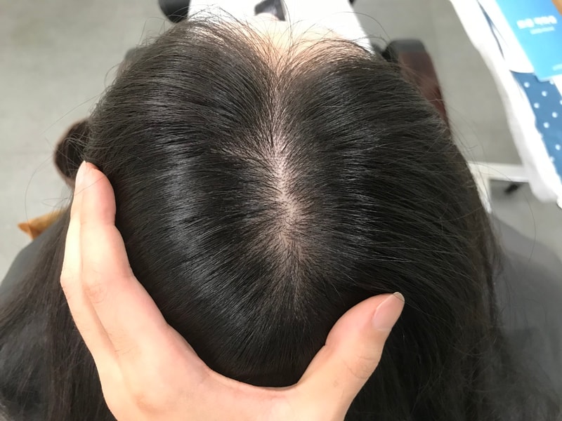 모발 볼륨 리프팅 + MTS 1회차 시술 후기
