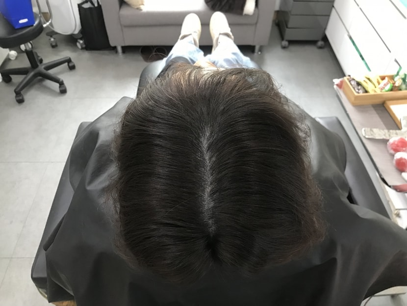 모발 볼륨 리프팅 받기 전