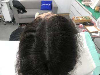 두피문신 1년후