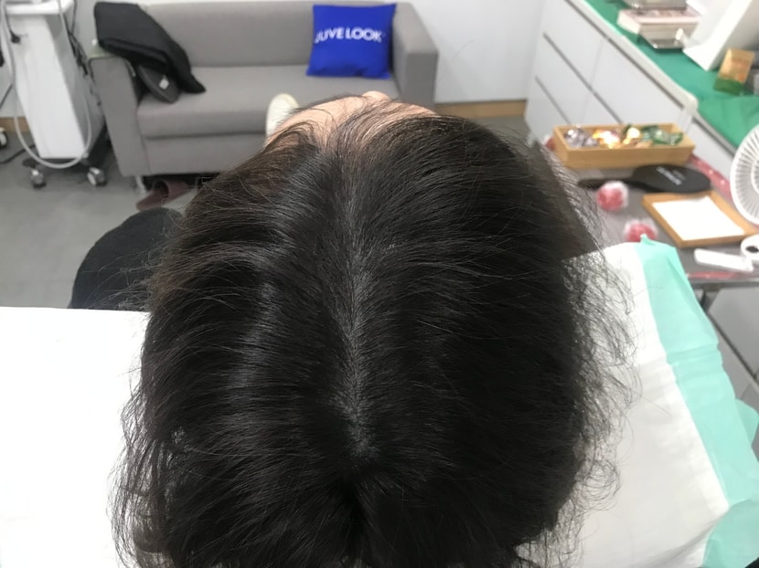 두피문신 1년후