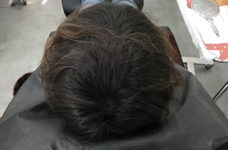 두피문신 리터치 후기입니다.