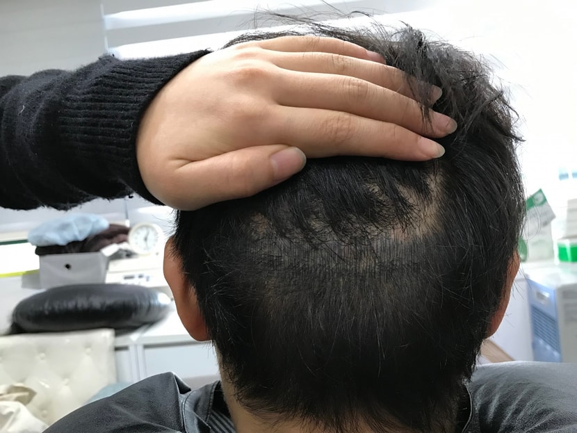 리터치전