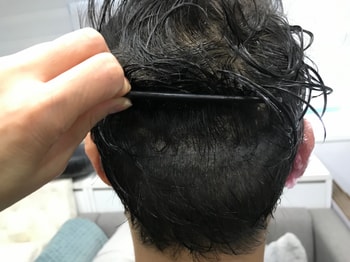 리터치후