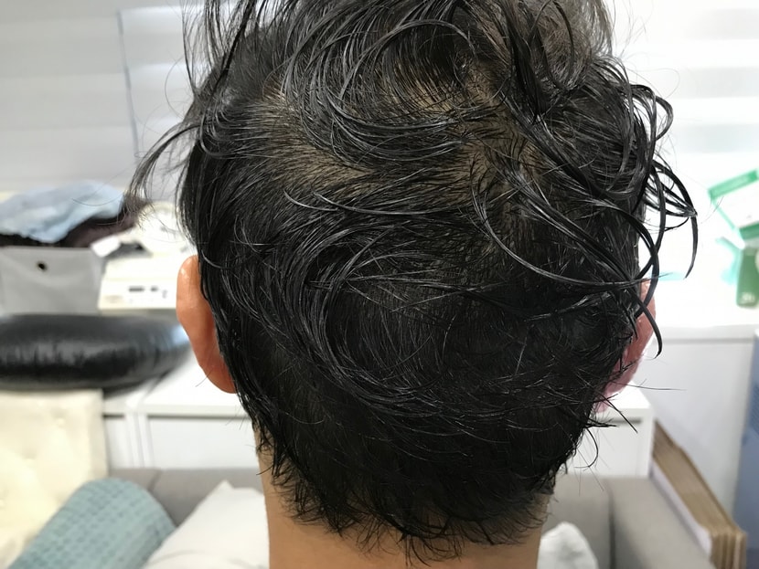 리터치후