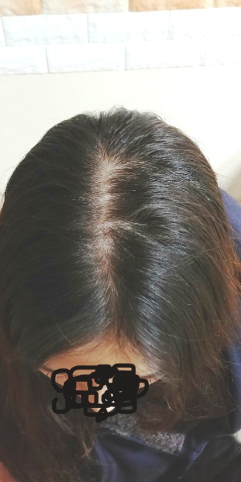 第2次3个月后，女性分头皮纹身