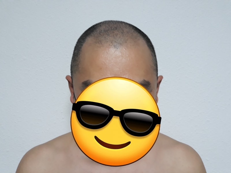 頭皮タトゥー後記