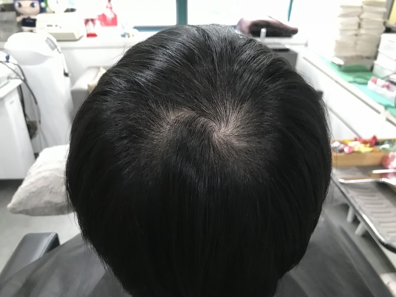 연세미다인에서 두피 문신하고온 후기 입니다!