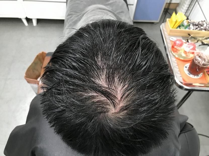 시술전 젖은 머리