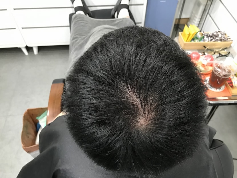 시술전 마른 머리