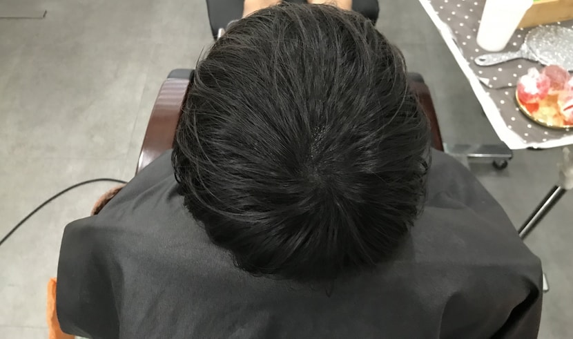 시술후