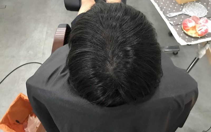 グラデーションドット技法頭皮タトゥーリタッチ体験談