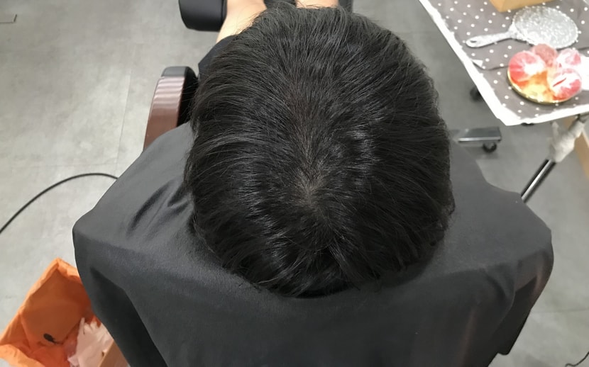 시술전