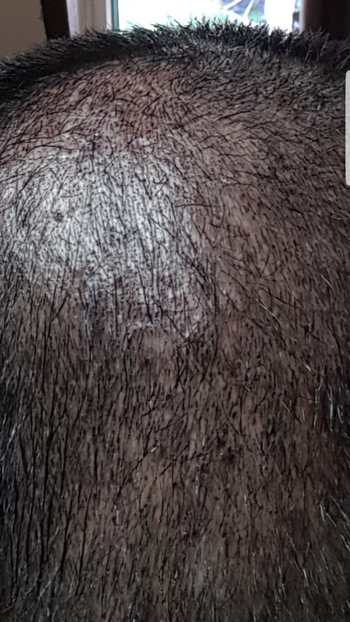 시술후 머리감기전