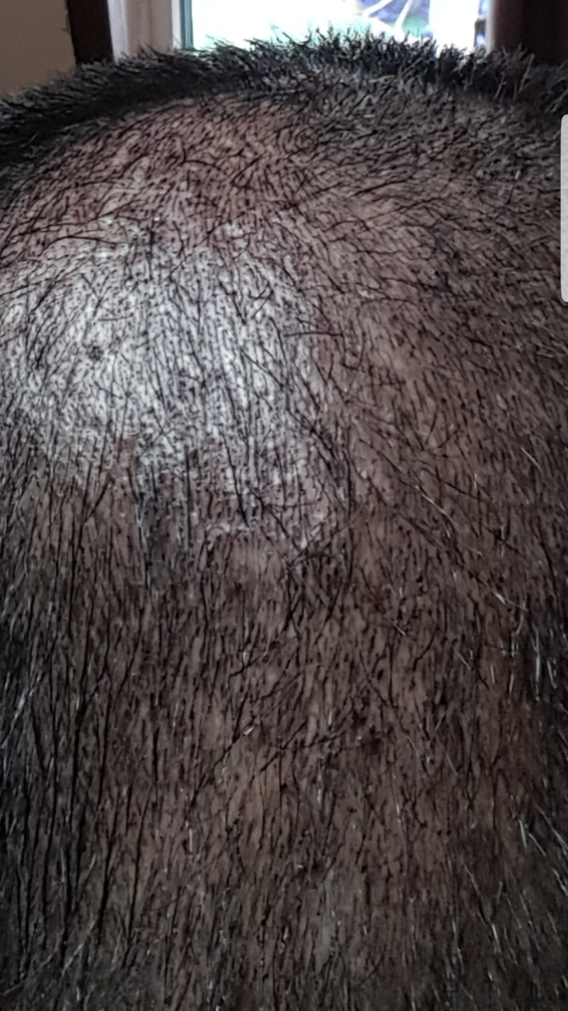 시술후 머리감기전