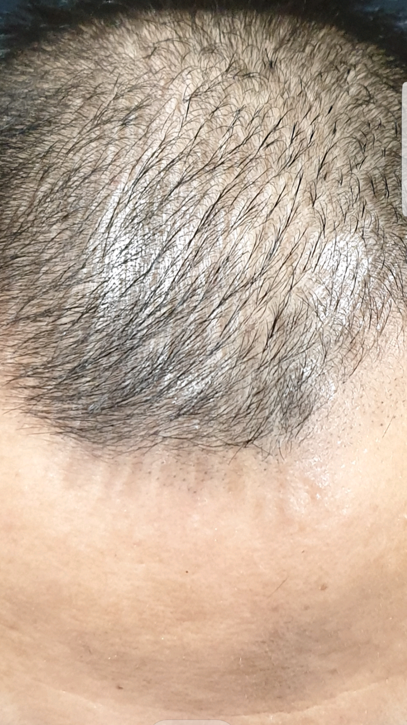 頭皮タトゥー1次の後