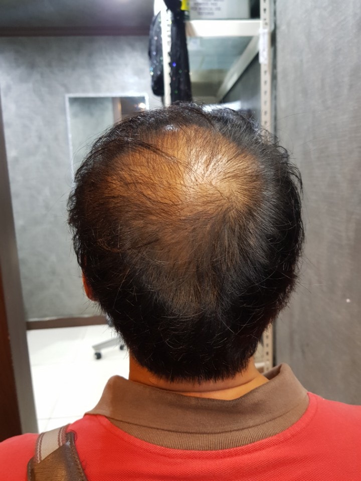 1차 시술전 뒷머리